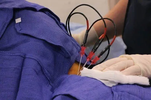 Nerve Block & Ablation at APICO Pain Management