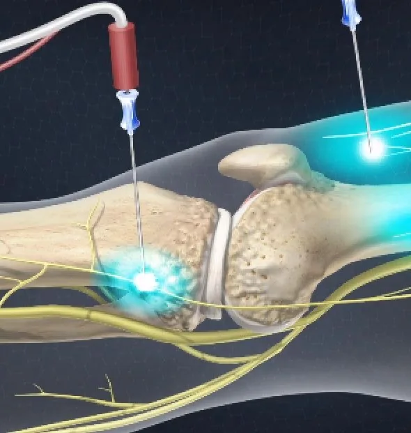 Basivertebral Nerve Ablation at APICO Pain Management