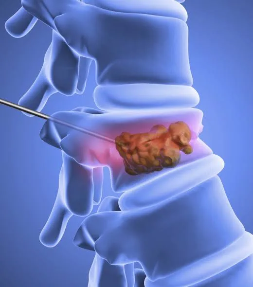 Kyphoplasty/Vertebroplasty at APICO Pain Management