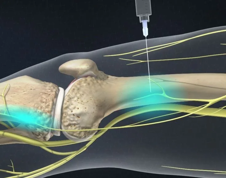 Nerve Blocks at APICO Pain Management