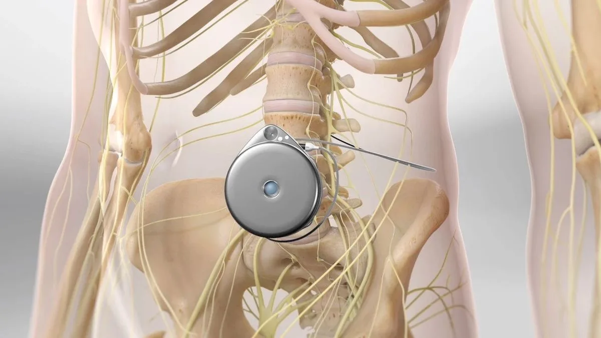 Intrathecal Pump Implantation at APICO Pain Management