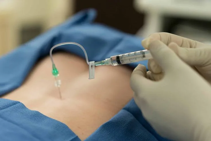Epidural Steroid Injections at APICO Pain Management