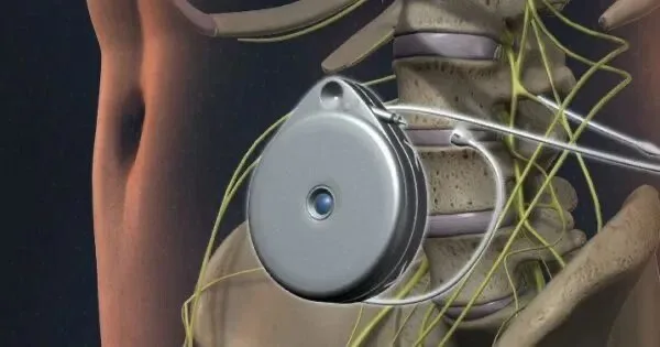 Intrathecal Pump Management at APICO Pain Management