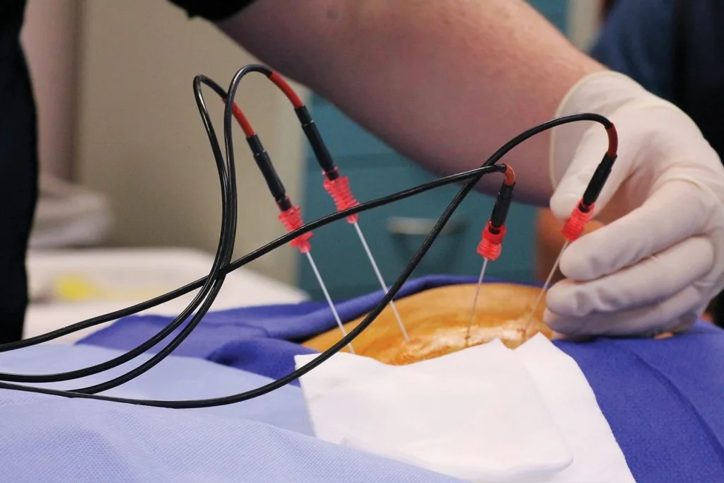 Sacroiliac Joint Ablation at APICO Pain Management