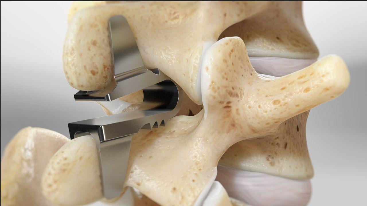 Dr. Rany T. Abdallah, board-certified pain management specialist in Interspinous Stabilization