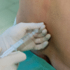 How Epidural Steroid Injections Help Reduce Inflammation